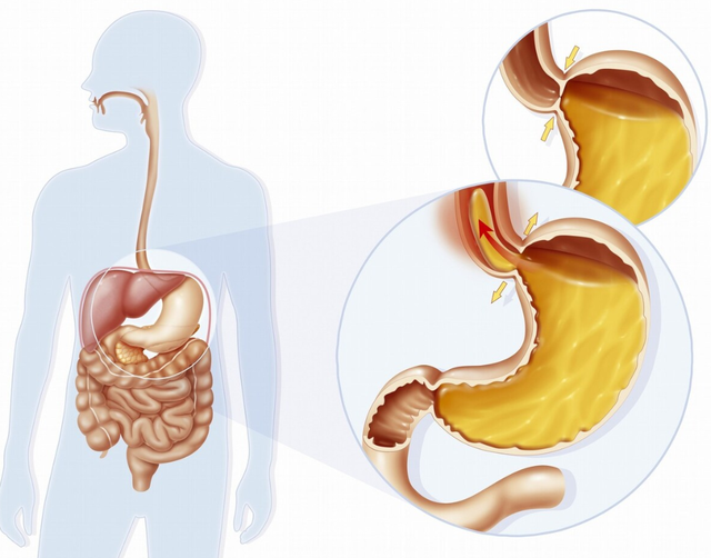 胃食管反流病检测