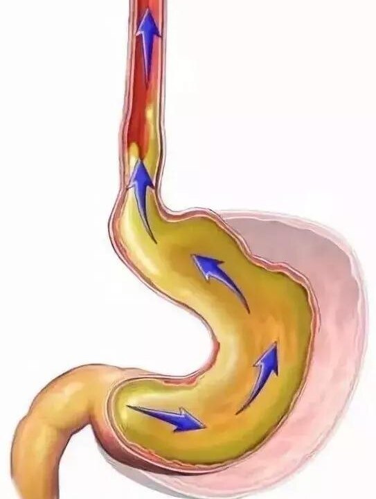 胃食管反流病检测